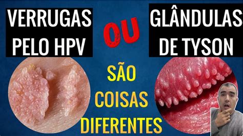 glandulas tyson o que é|Glândulas de Tyson: o que é, causas e sintomas